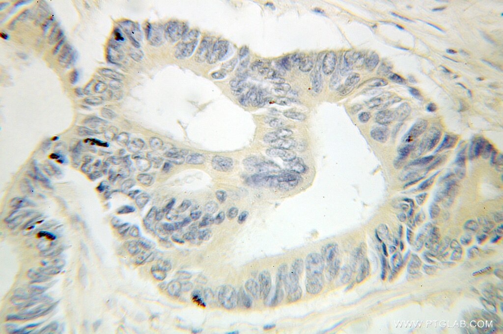 Immunohistochemistry (IHC) staining of human colon cancer tissue using HOOK1 Polyclonal antibody (10871-1-AP)