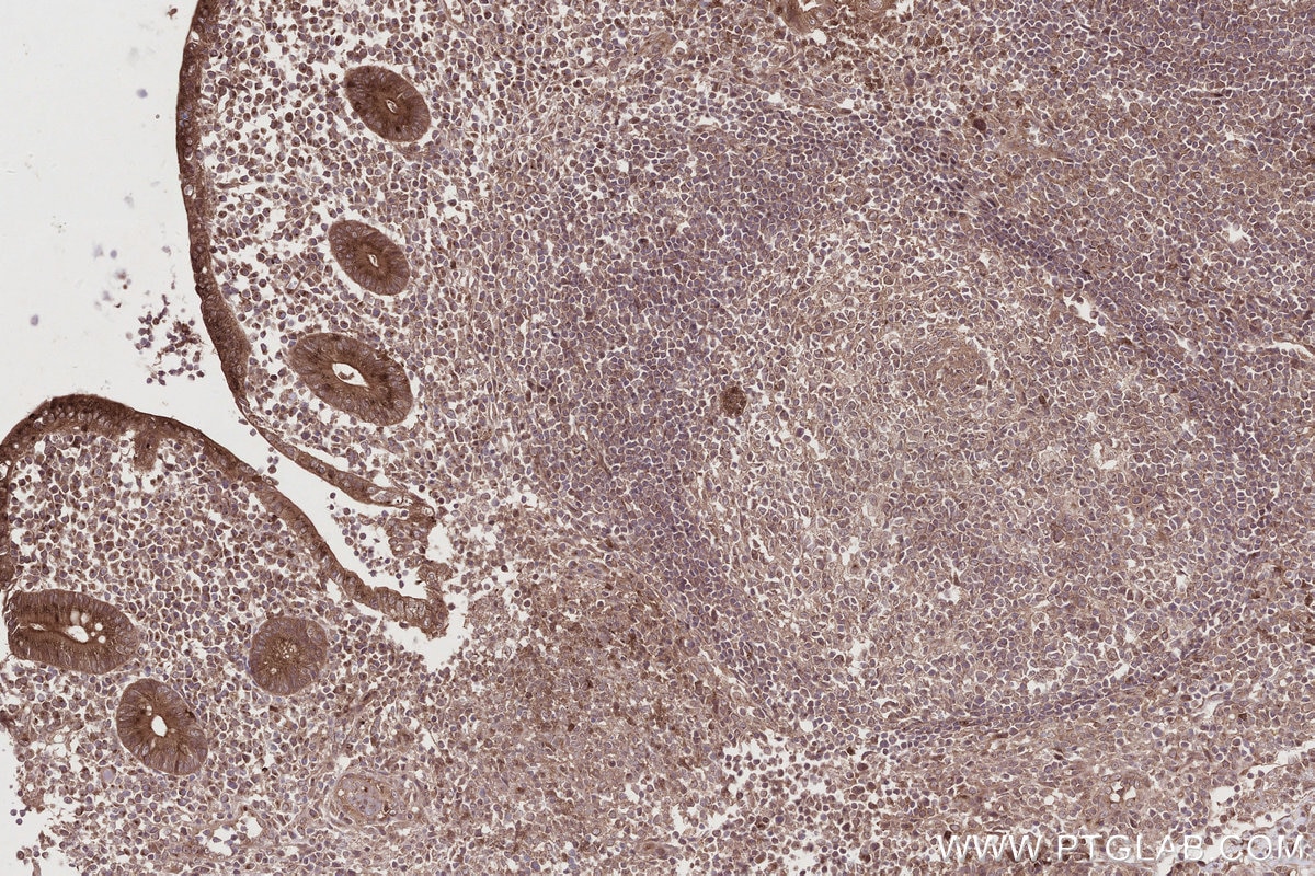 IHC staining of human appendicitis using 32110-1-AP Immunohistochemistry (IHC) staining of human appendicitis tissue using HOOK2 Polyclonal antibody (32110-1-AP)