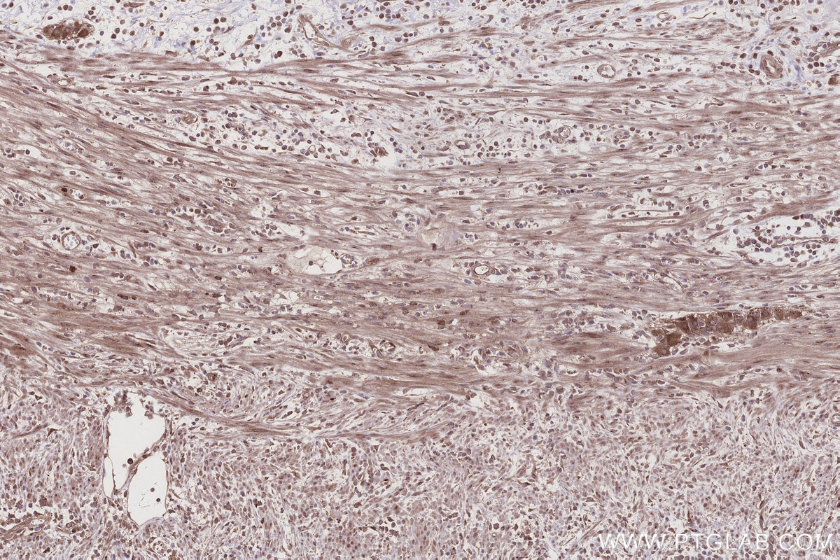 IHC staining of human appendicitis using 32110-1-AP Immunohistochemistry (IHC) staining of human appendicitis tissue using HOOK2 Polyclonal antibody (32110-1-AP)