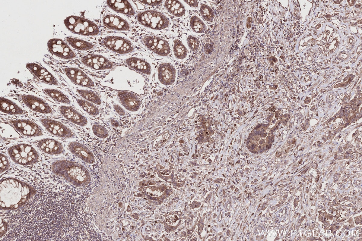 IHC staining of human rectal cancer using 32110-1-AP Immunohistochemistry (IHC) staining of human rectal cancer tissue using HOOK2 Polyclonal antibody (32110-1-AP)