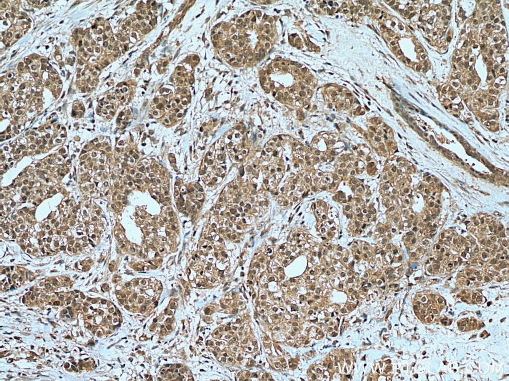 IHC staining of human breast cancer using 28719-1-AP