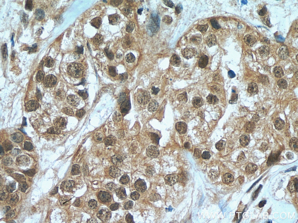 Immunohistochemistry (IHC) staining of human breast cancer tissue using HORMAD1 Polyclonal antibody (28719-1-AP)