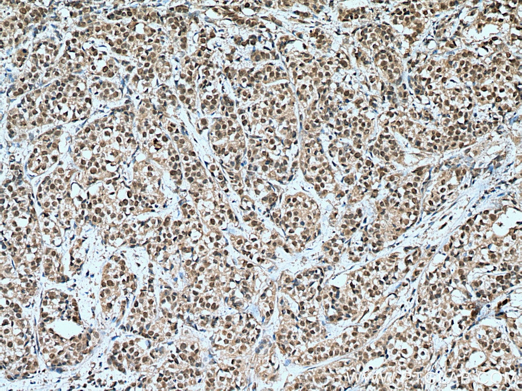 Immunohistochemistry (IHC) staining of human breast cancer tissue using HORMAD1 Monoclonal antibody (67091-1-Ig)