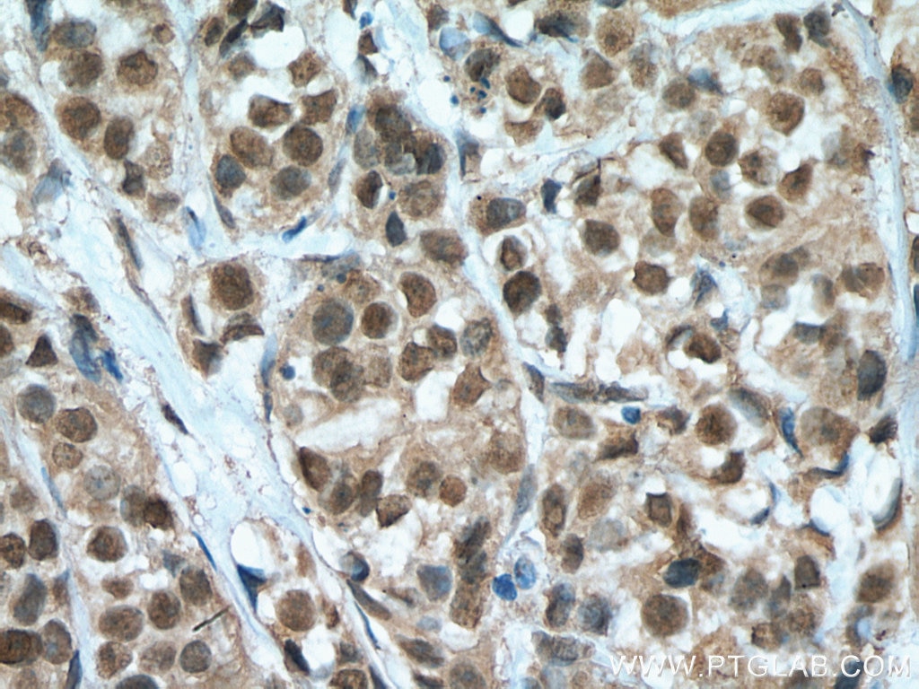Immunohistochemistry (IHC) staining of human breast cancer tissue using HORMAD1 Monoclonal antibody (67091-1-Ig)