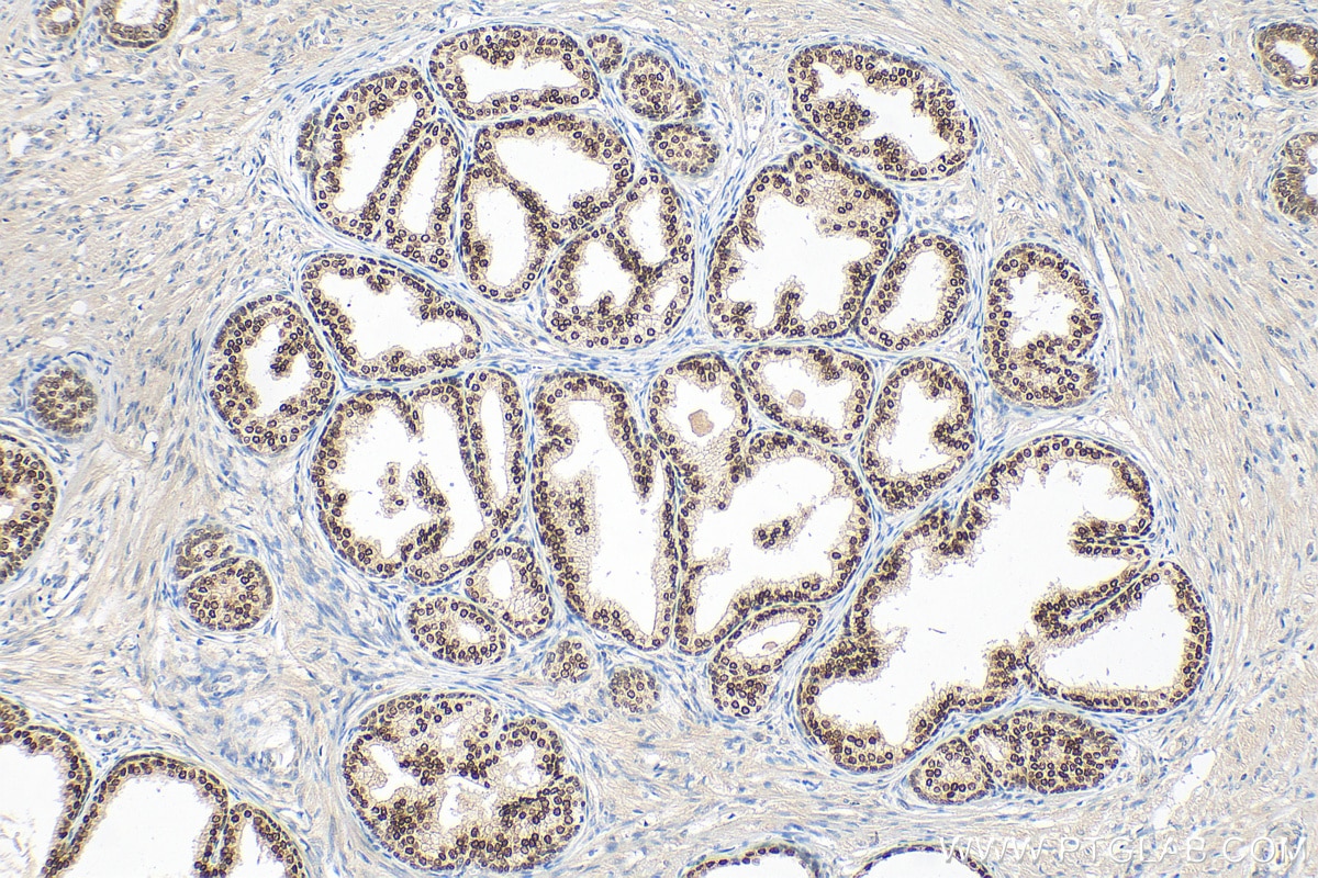 IHC staining of human prostate cancer using 26384-1-AP