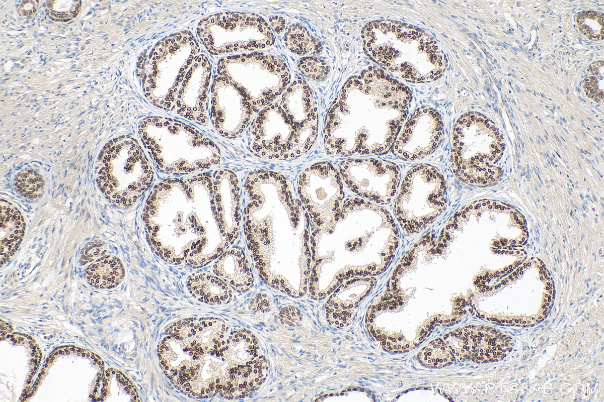 Immunohistochemistry (IHC) staining of human prostate cancer tissue using HOXB13 Polyclonal antibody (26384-1-AP)