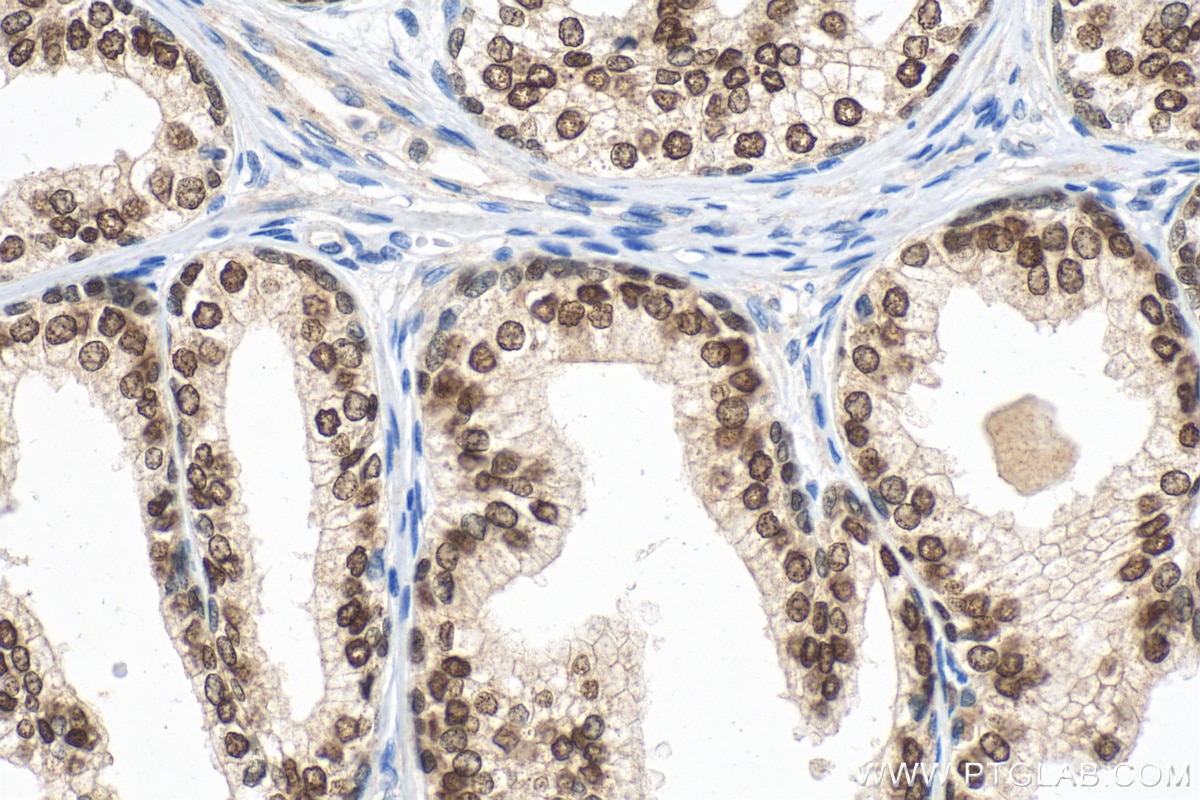 Immunohistochemistry (IHC) staining of human prostate cancer tissue using HOXB13 Polyclonal antibody (26384-1-AP)