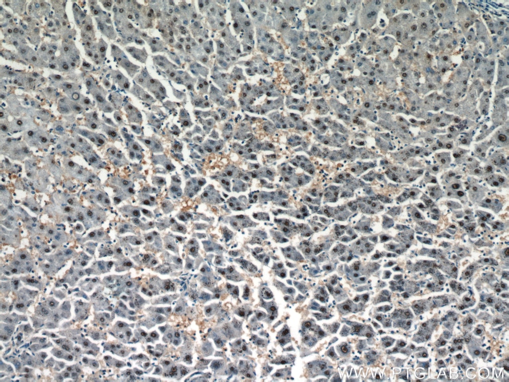 Immunohistochemistry (IHC) staining of human hepatocirrhosis tissue using HOXD13 Polyclonal antibody (18736-1-AP)