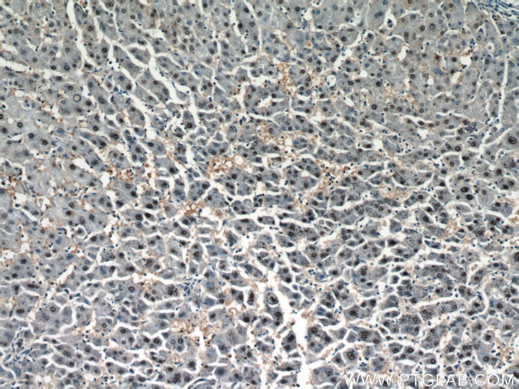 Immunohistochemistry (IHC) staining of human hepatocirrhosis tissue using HOXD13 Polyclonal antibody (18736-1-AP)