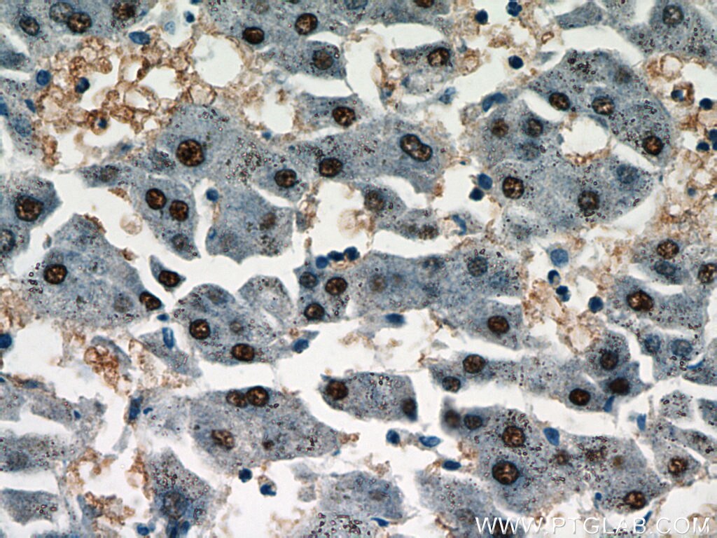 Immunohistochemistry (IHC) staining of human hepatocirrhosis tissue using HOXD13 Polyclonal antibody (18736-1-AP)