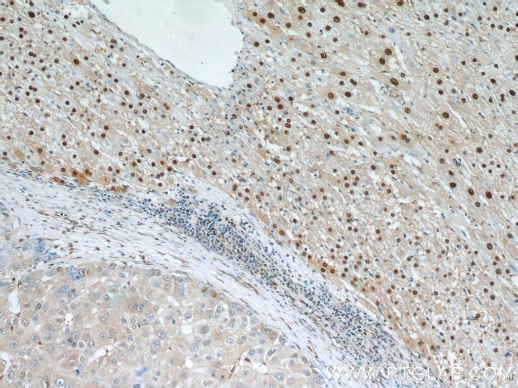 Immunohistochemistry (IHC) staining of human liver cancer tissue using HOXD13 Polyclonal antibody (18736-1-AP)