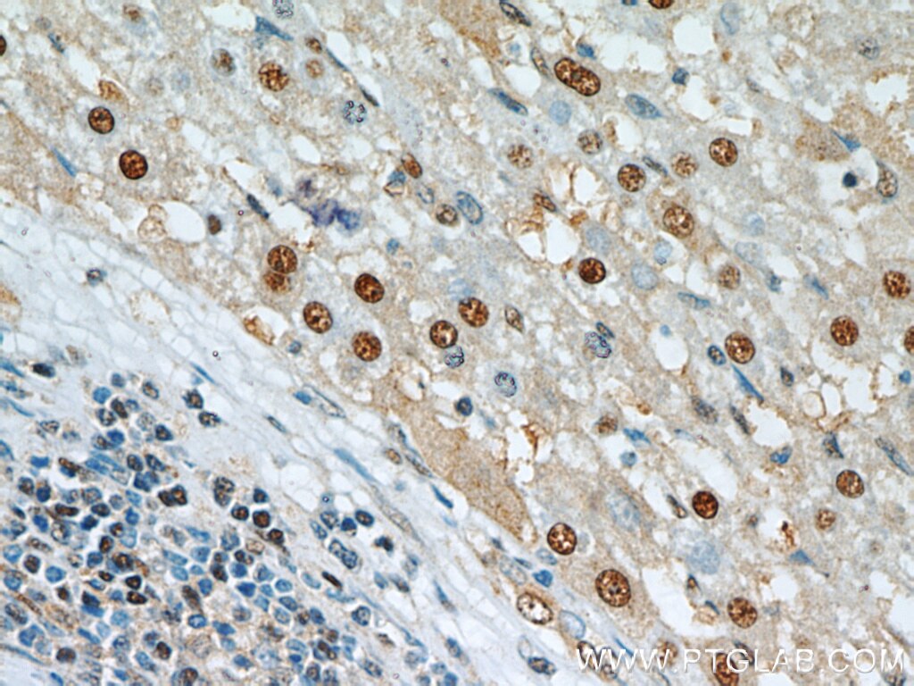 Immunohistochemistry (IHC) staining of human liver cancer tissue using HOXD13 Polyclonal antibody (18736-1-AP)
