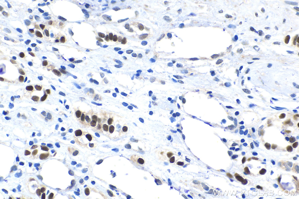 IHC staining of human renal cell carcinoma using 18588-1-AP Immunohistochemistry (IHC) staining of human renal cell carcinoma tissue using HOXD8 Polyclonal antibody (18588-1-AP)