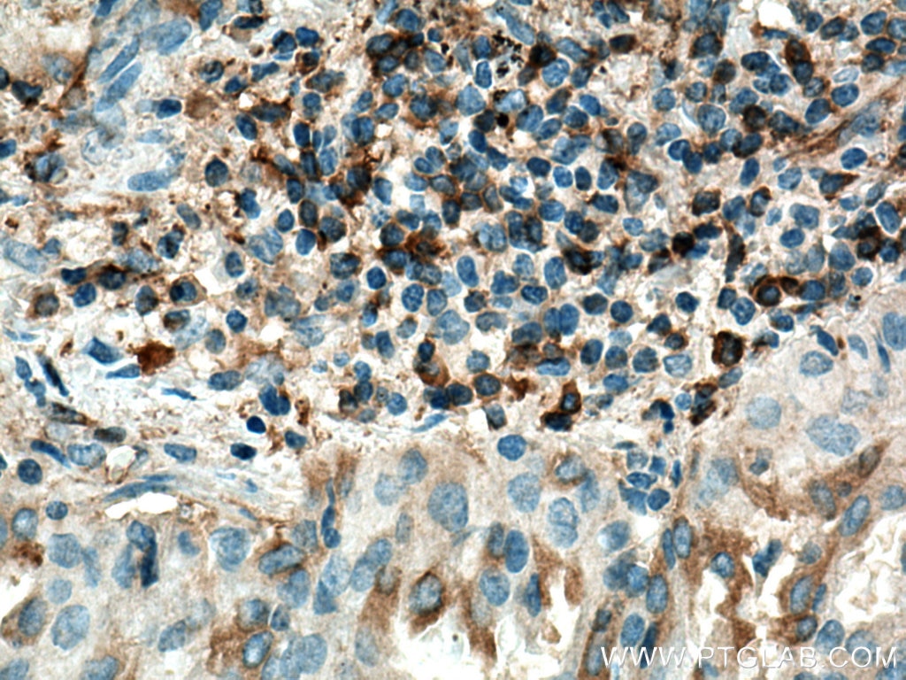 Immunohistochemistry (IHC) staining of human lung cancer tissue using Haptoglobin Polyclonal antibody (16665-1-AP)