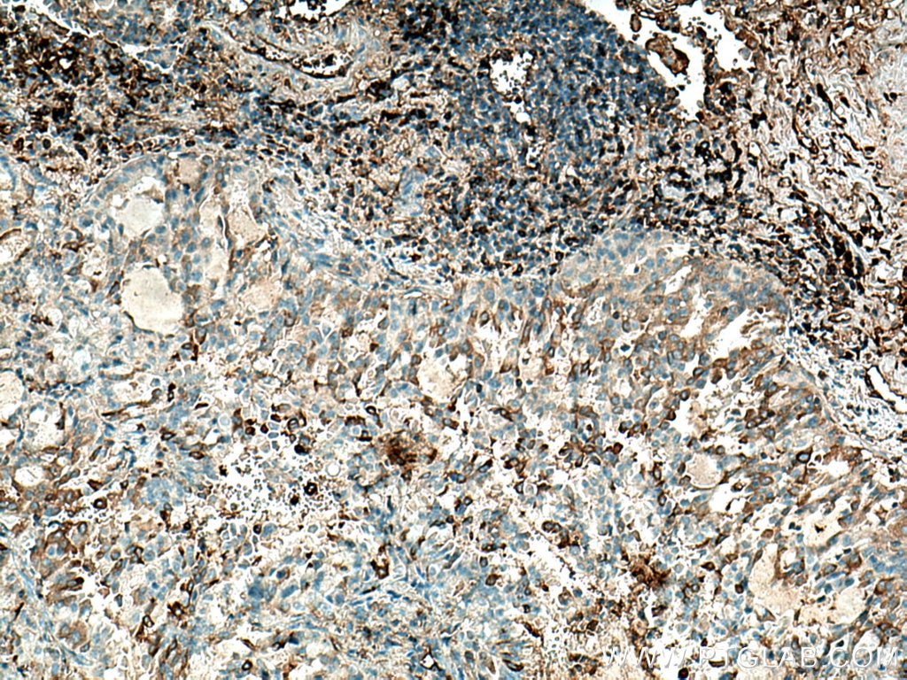 Immunohistochemistry (IHC) staining of human lung cancer tissue using Haptoglobin Polyclonal antibody (16665-1-AP)