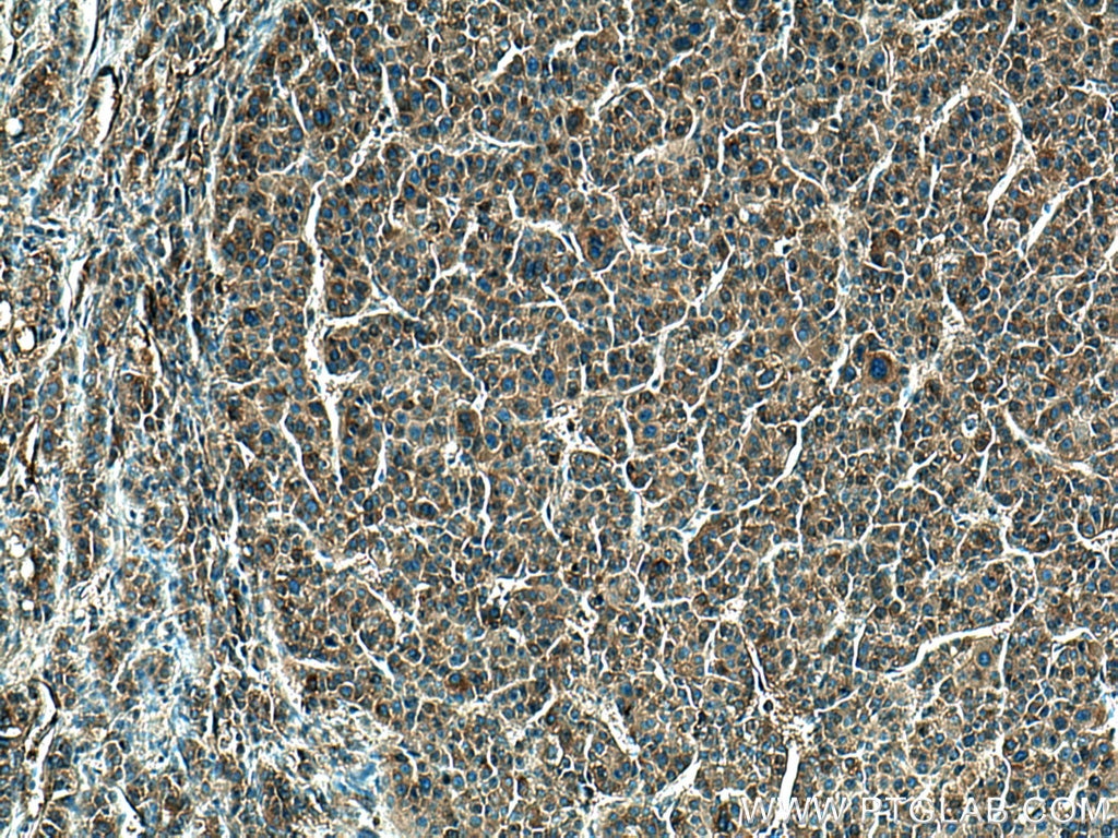 IHC staining of human liver cancer using 16665-1-AP