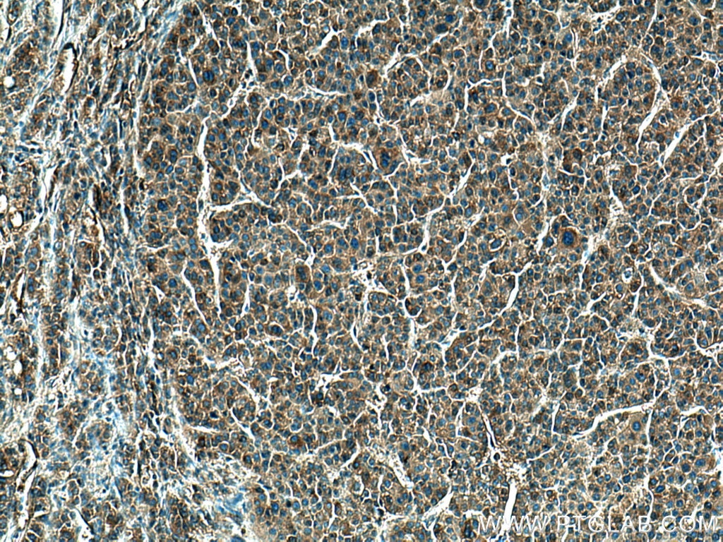 Immunohistochemistry (IHC) staining of human liver cancer tissue using Haptoglobin Polyclonal antibody (16665-1-AP)