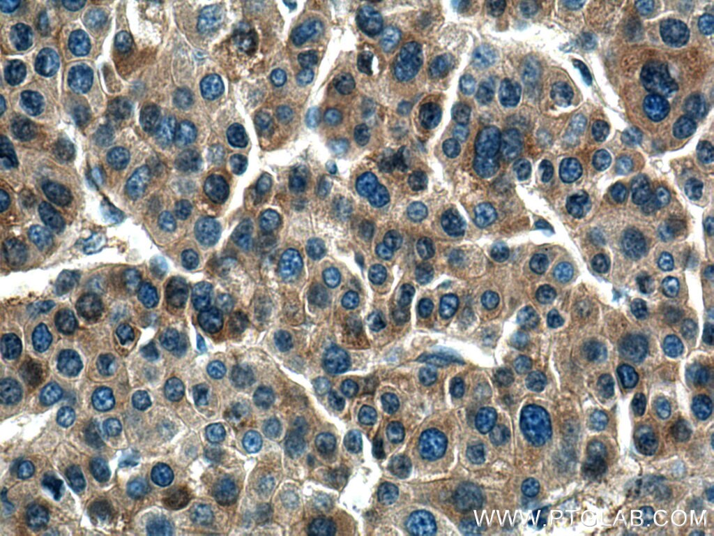 Immunohistochemistry (IHC) staining of human liver cancer tissue using Haptoglobin Polyclonal antibody (16665-1-AP)