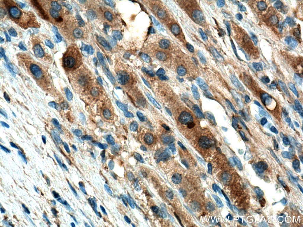 Immunohistochemistry (IHC) staining of human liver cancer tissue using Haptoglobin Polyclonal antibody (16665-1-AP)