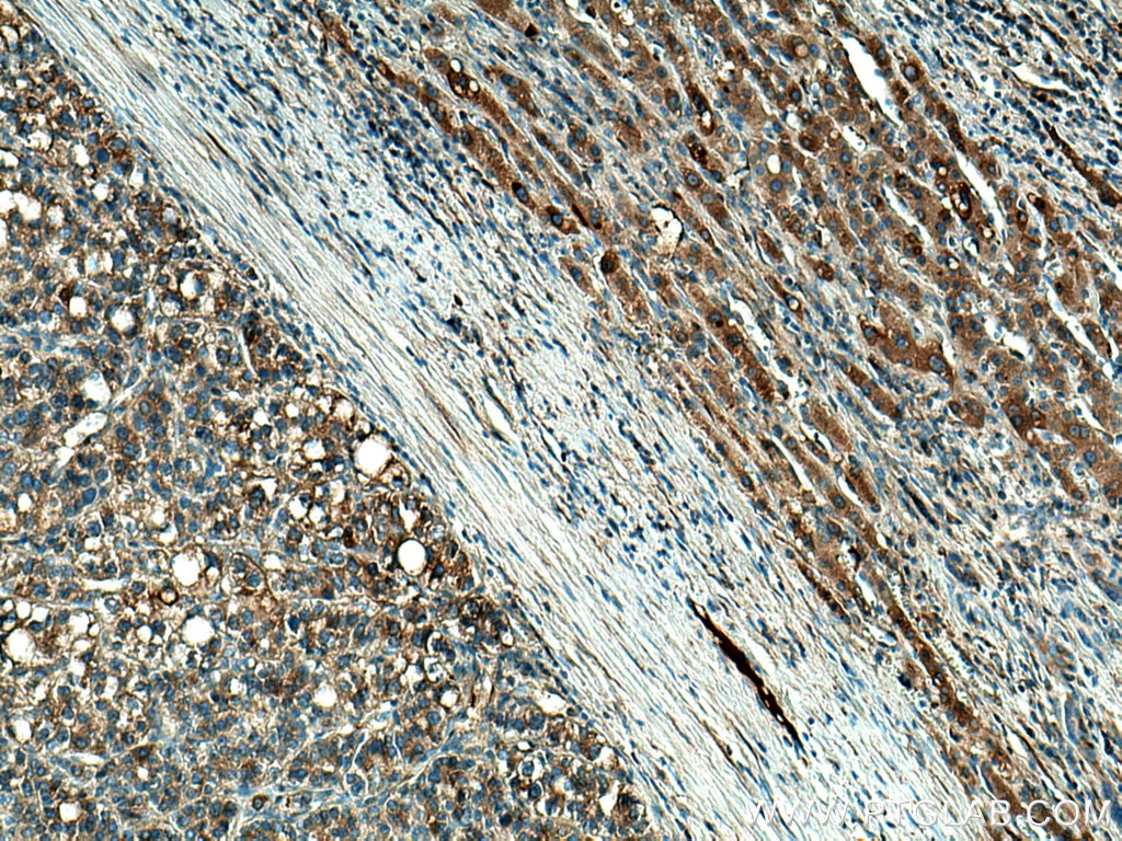 Immunohistochemistry (IHC) staining of human liver cancer tissue using Haptoglobin Polyclonal antibody (16665-1-AP)