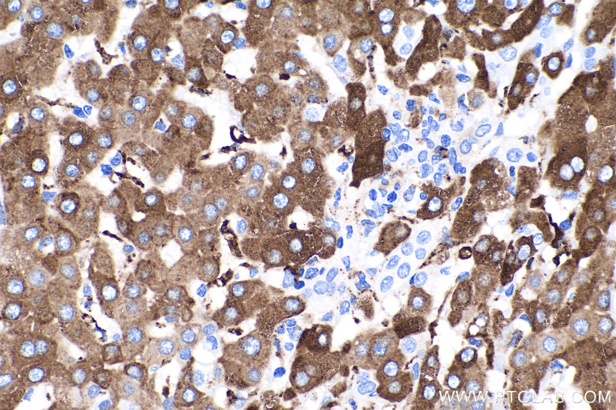 Immunohistochemistry (IHC) staining of human liver cancer tissue using Haptoglobin Monoclonal antibody (66229-1-Ig)