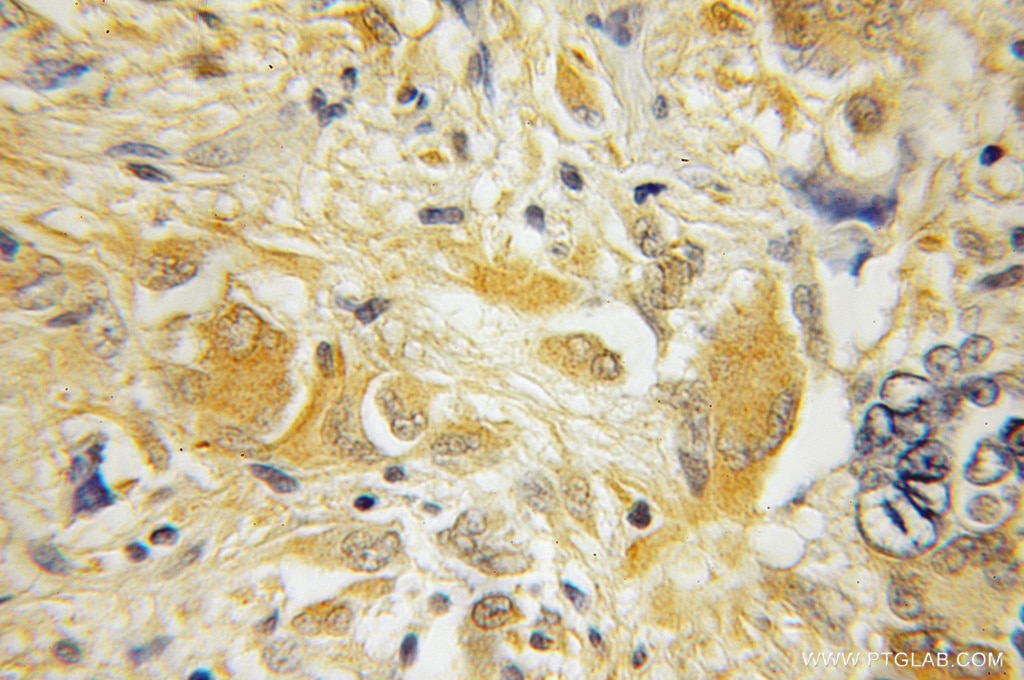 Immunohistochemistry (IHC) staining of human medulloblastoma tissue using HPCAL4 Polyclonal antibody (12470-1-AP)
