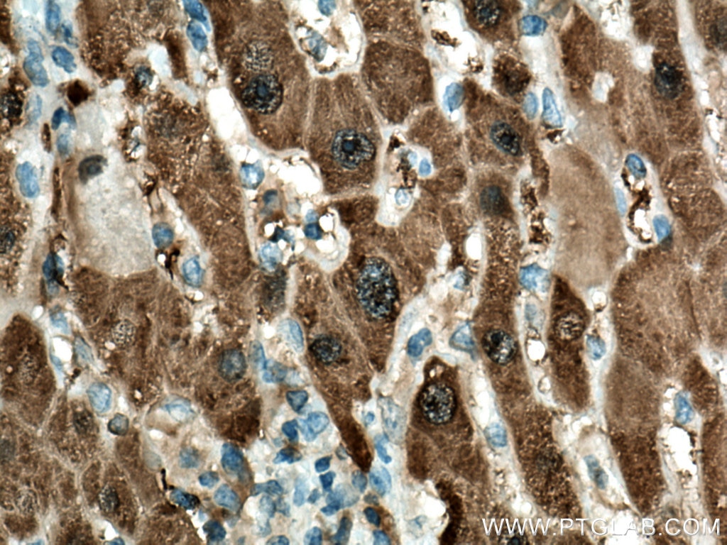Immunohistochemistry (IHC) staining of human liver cancer tissue using HPD Monoclonal antibody (67552-1-Ig)