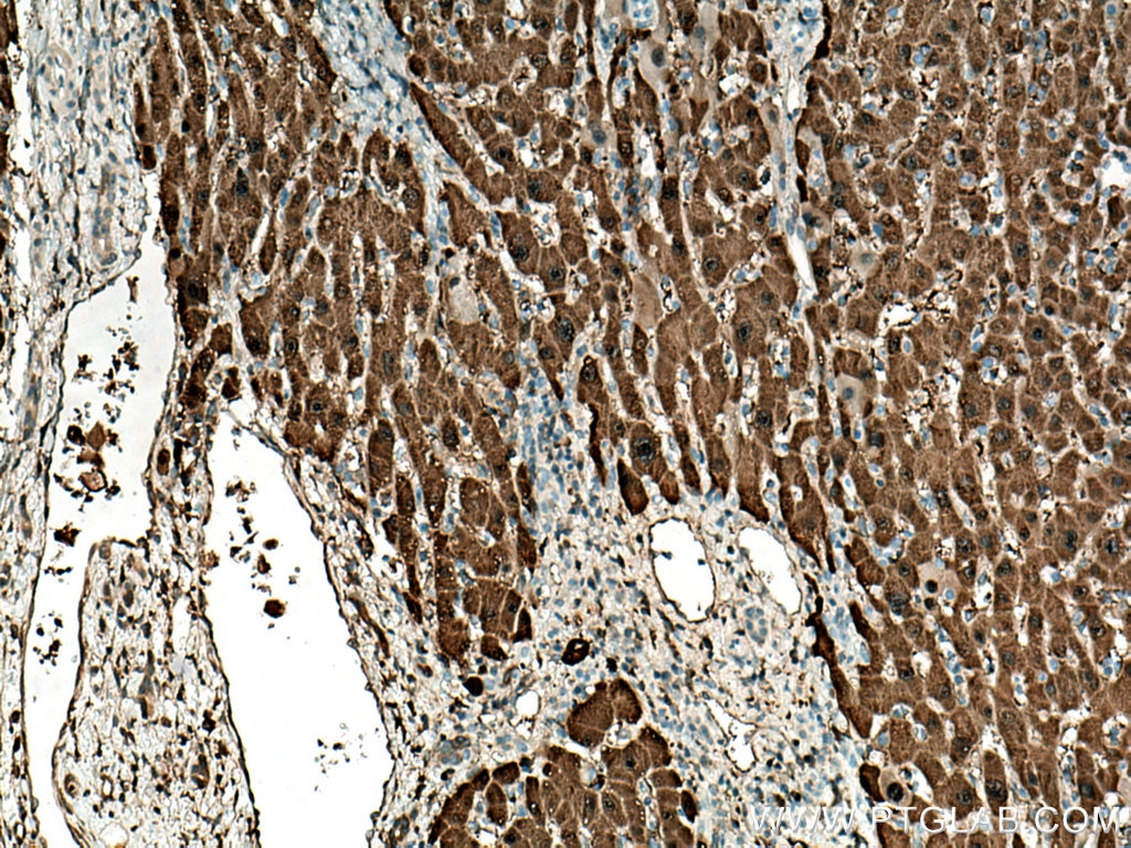 Immunohistochemistry (IHC) staining of human liver cancer tissue using HPD Monoclonal antibody (67552-1-Ig)