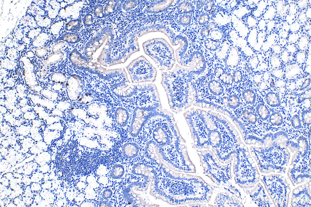 Immunohistochemistry (IHC) staining of human stomach cancer tissue using HPDL Polyclonal antibody (20777-1-AP)