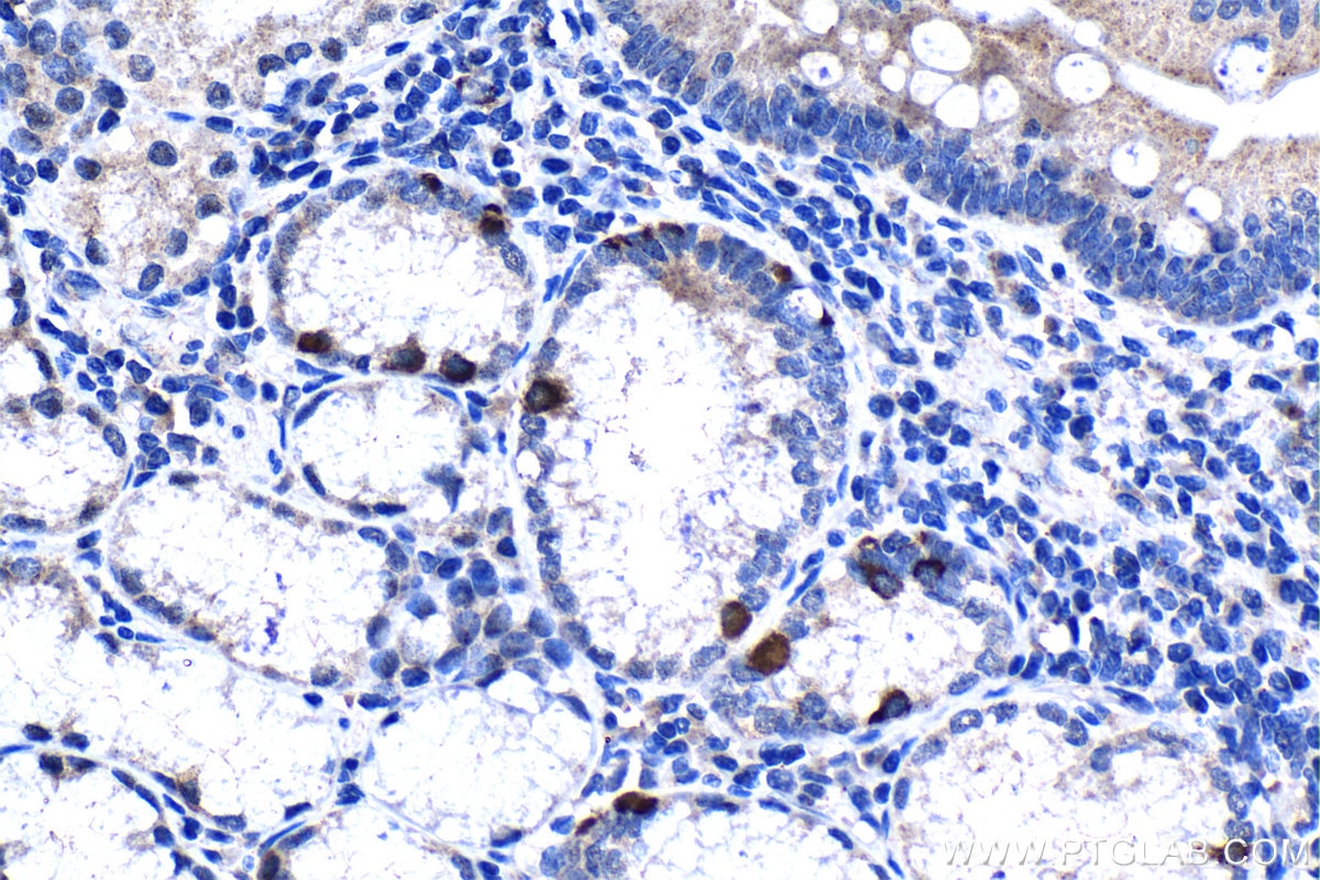 Immunohistochemistry (IHC) staining of human stomach cancer tissue using HPDL Polyclonal antibody (20777-1-AP)