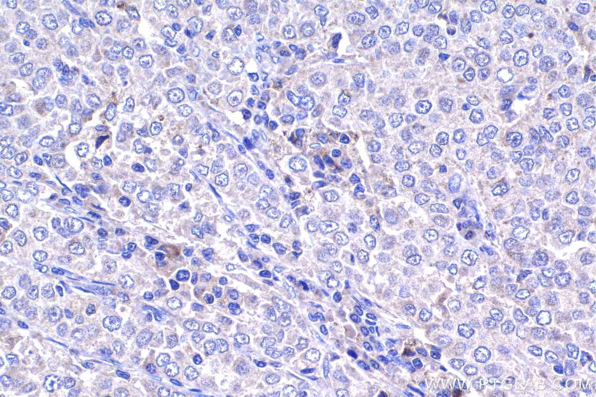 Immunohistochemistry (IHC) staining of human ovary tumor tissue using HPDL Polyclonal antibody (20777-1-AP)