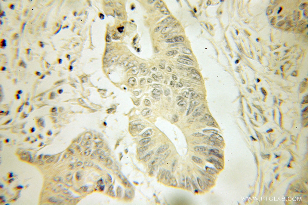 Immunohistochemistry (IHC) staining of human colon cancer tissue using HPGD Polyclonal antibody (11035-1-AP)