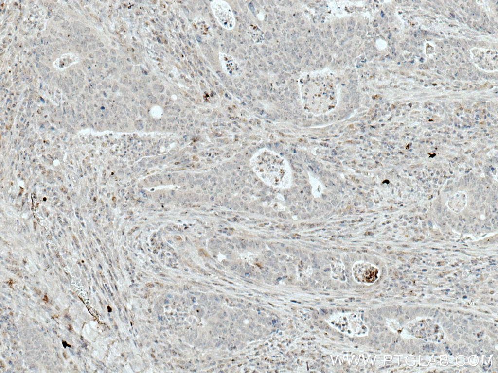 IHC staining of human colon cancer using 66798-1-Ig