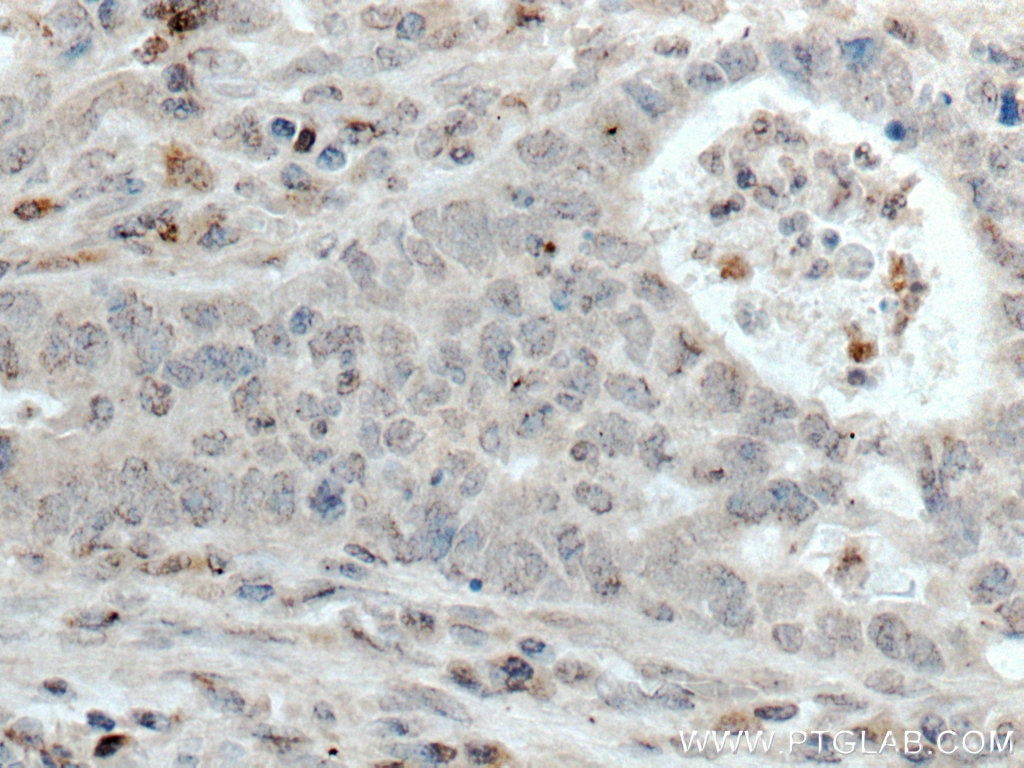 Immunohistochemistry (IHC) staining of human colon cancer tissue using HPGD Monoclonal antibody (66798-1-Ig)