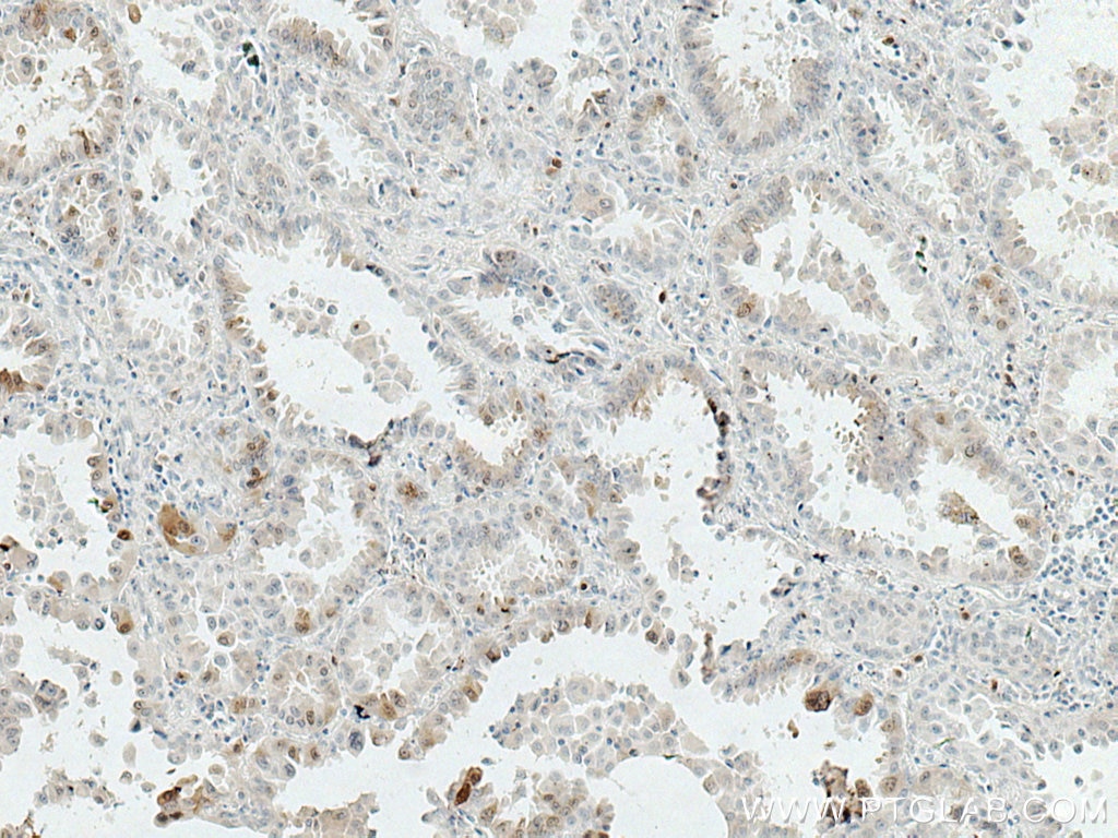 Immunohistochemistry (IHC) staining of human lung cancer tissue using HPGD Monoclonal antibody (66798-1-Ig)