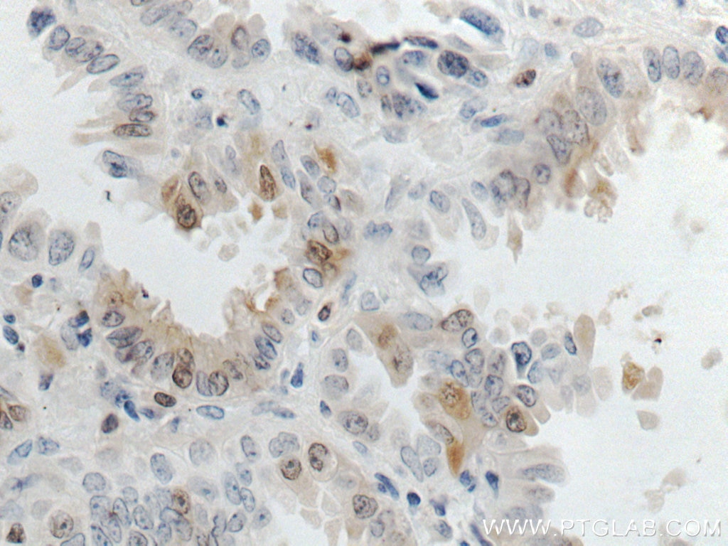 IHC staining of human lung cancer using 66798-1-Ig