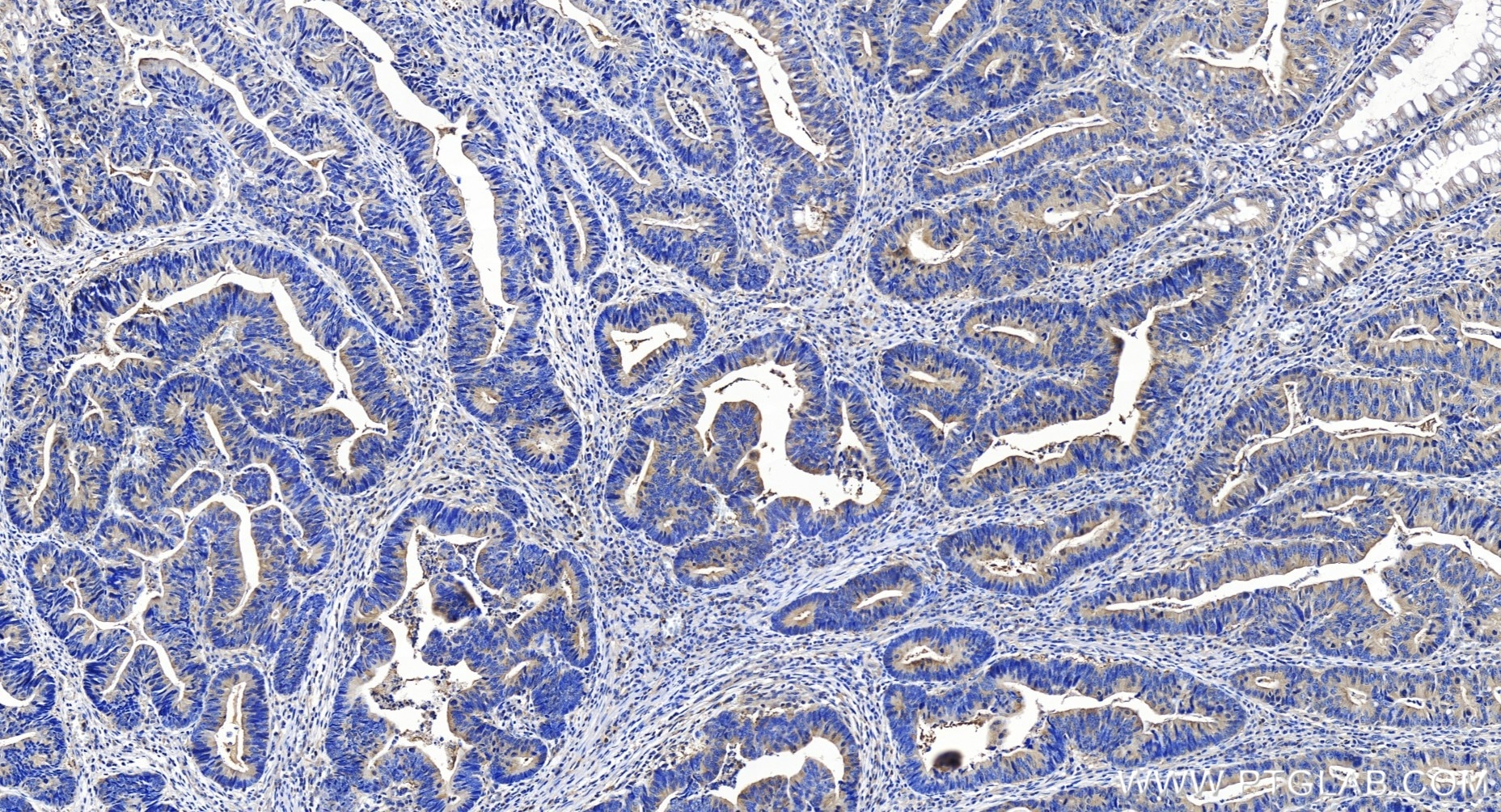 Immunohistochemistry (IHC) staining of human colon cancer tissue using HPRT Recombinant antibody (86049-1-RR)