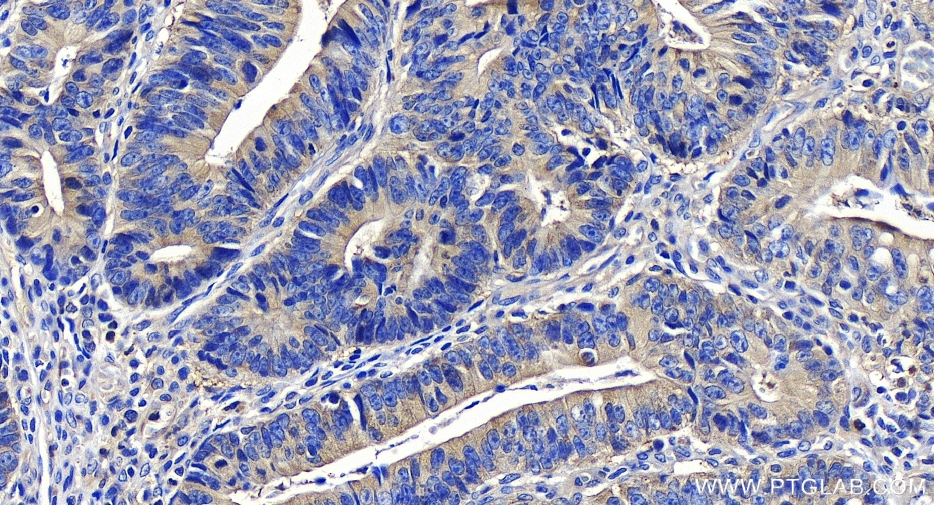 Immunohistochemistry (IHC) staining of human colon cancer tissue using HPRT Recombinant antibody (86049-1-RR)
