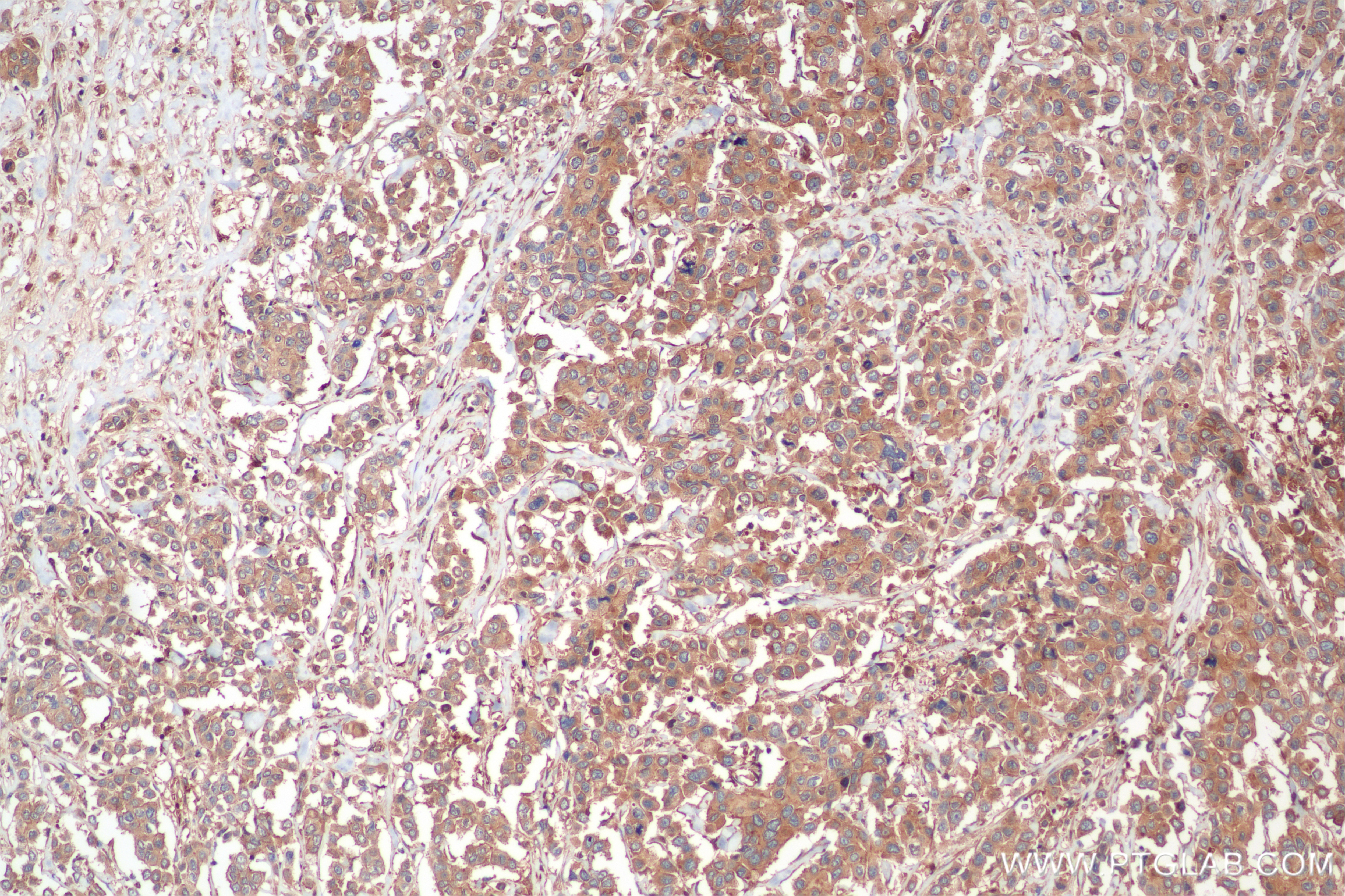 Immunohistochemistry (IHC) staining of human breast cancer tissue using HPRT Recombinant antibody (86049-1-RR)