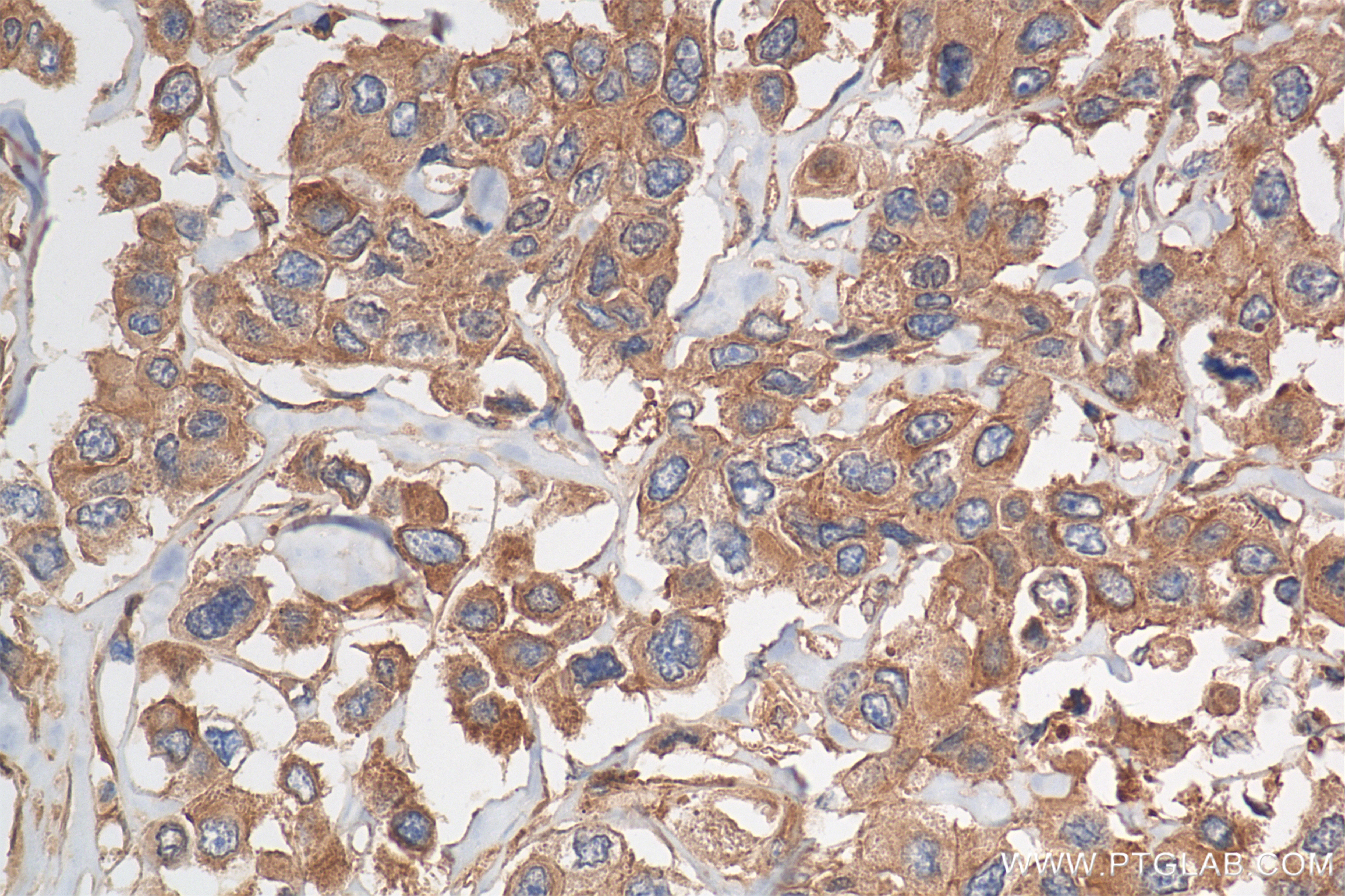 Immunohistochemistry (IHC) staining of human breast cancer tissue using HPRT Recombinant antibody (86049-1-RR)