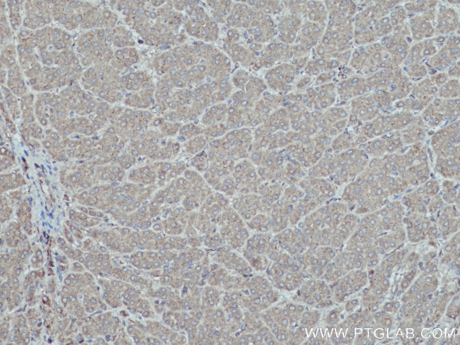 Immunohistochemistry (IHC) staining of human liver cancer tissue using HPRT1 Polyclonal antibody (15059-1-AP)