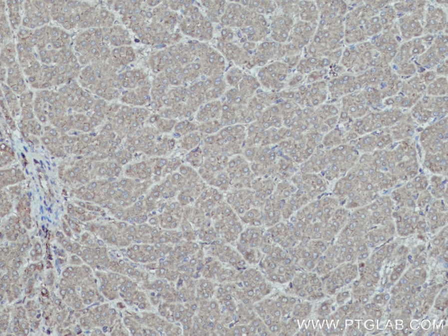 IHC staining of human liver cancer using 15059-1-AP