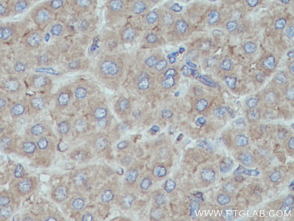 Immunohistochemistry (IHC) staining of human liver cancer tissue using HPRT1 Polyclonal antibody (15059-1-AP)