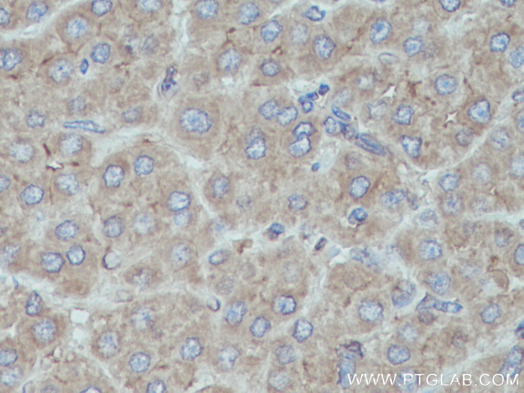 Immunohistochemistry (IHC) staining of human liver cancer tissue using HPRT1 Polyclonal antibody (15059-1-AP)