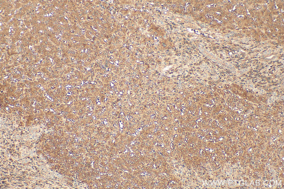 Immunohistochemistry (IHC) staining of human liver cancer tissue using HPRT Polyclonal antibody (15059-1-AP)