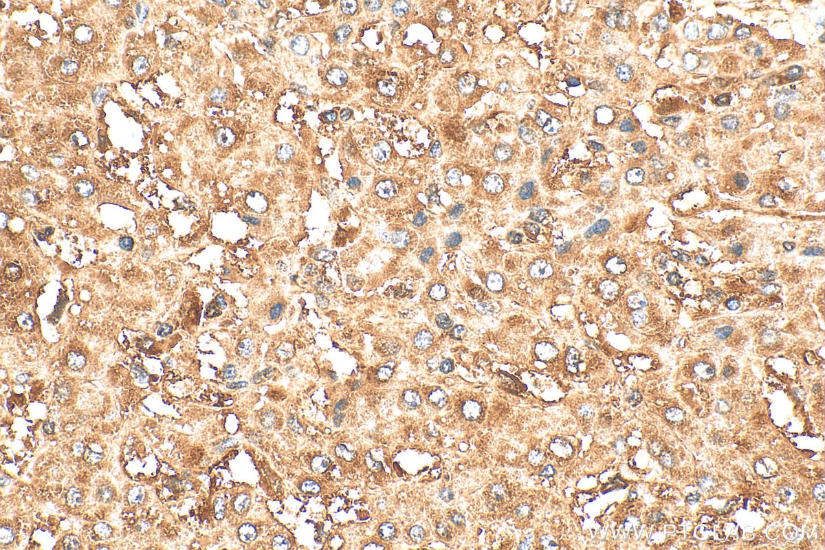 Immunohistochemistry (IHC) staining of human liver cancer tissue using HPRT Polyclonal antibody (15059-1-AP)