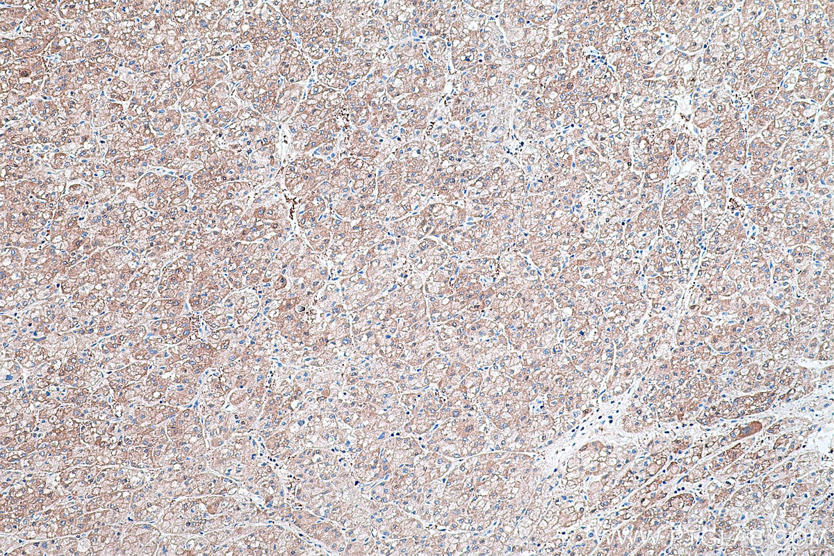 Immunohistochemistry (IHC) staining of human liver cancer tissue using HPRT1 Monoclonal antibody (67518-1-Ig)