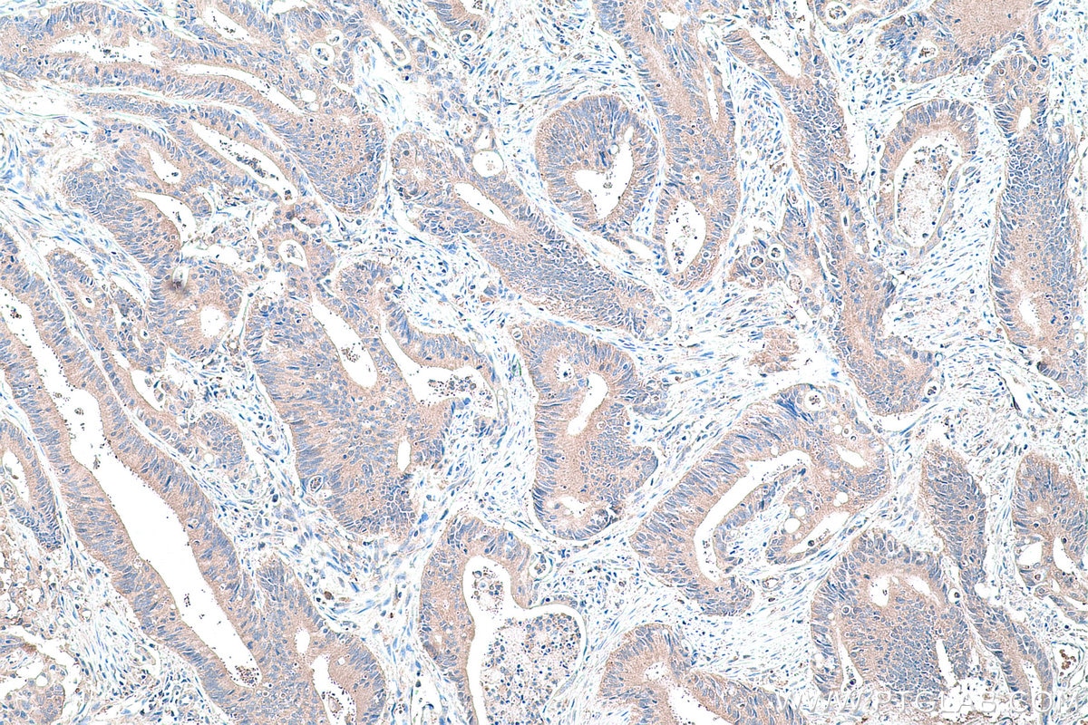 Immunohistochemistry (IHC) staining of human colon cancer tissue using HPRT1 Monoclonal antibody (67518-1-Ig)