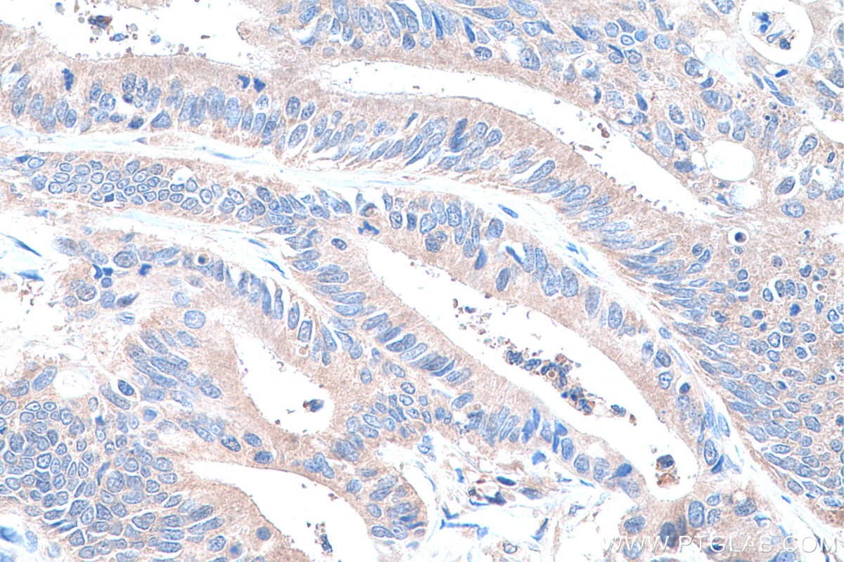 Immunohistochemistry (IHC) staining of human colon cancer tissue using HPRT1 Monoclonal antibody (67518-1-Ig)