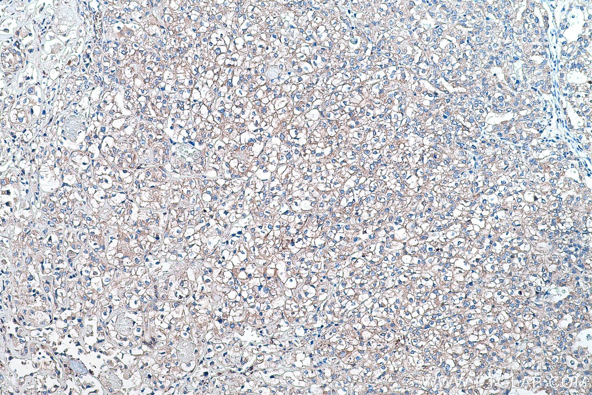 IHC staining of human endometrial cancer using 67518-1-Ig